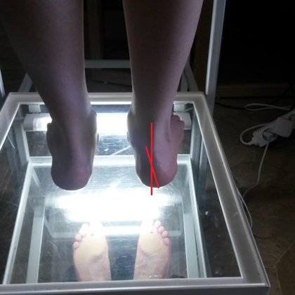 Pes valgus