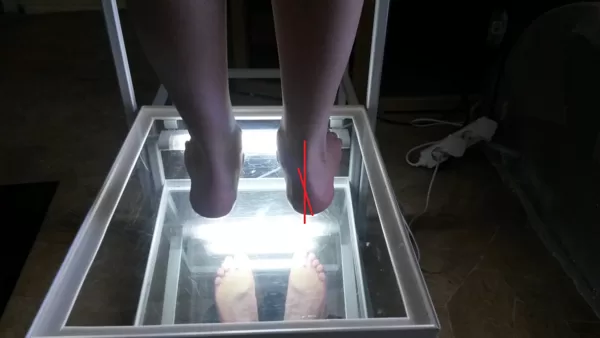 Pes valgus